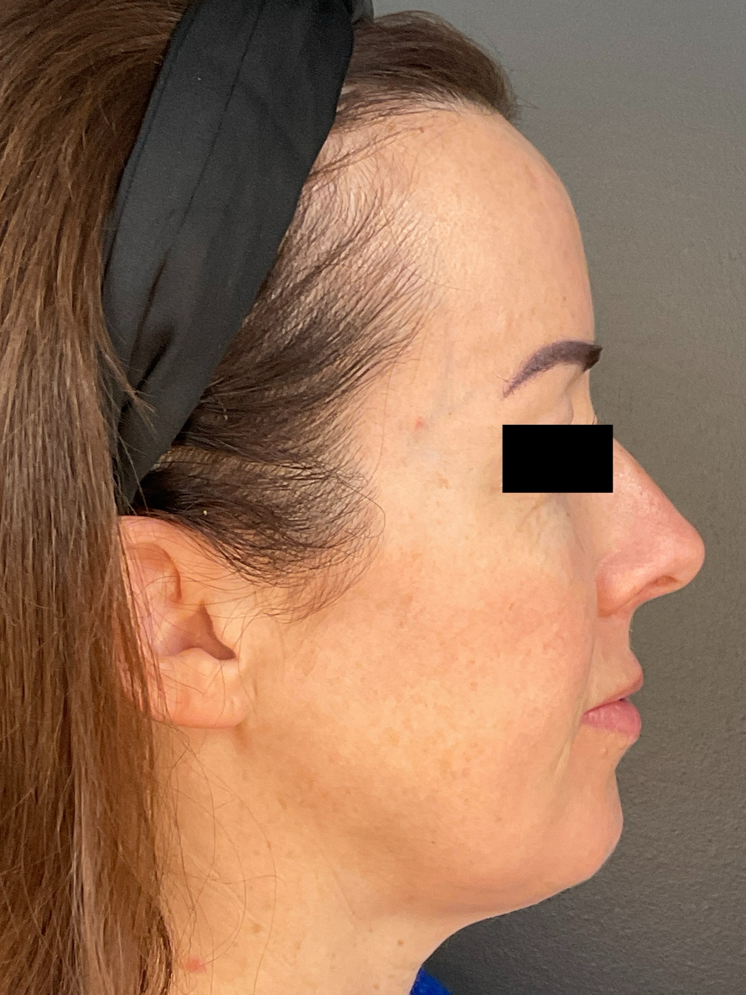 Contour: Right Profile-before