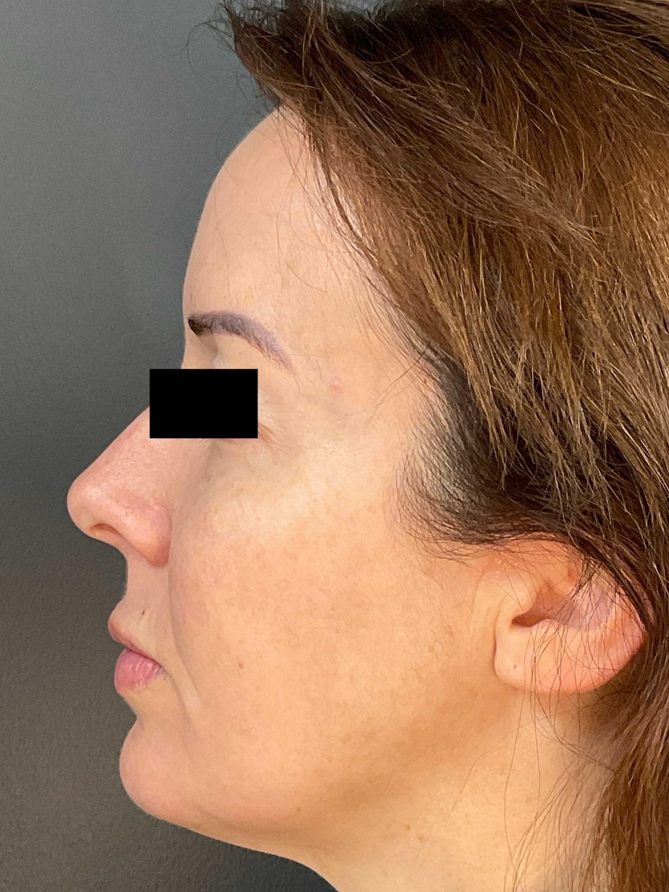 Contour: Left Profile-after