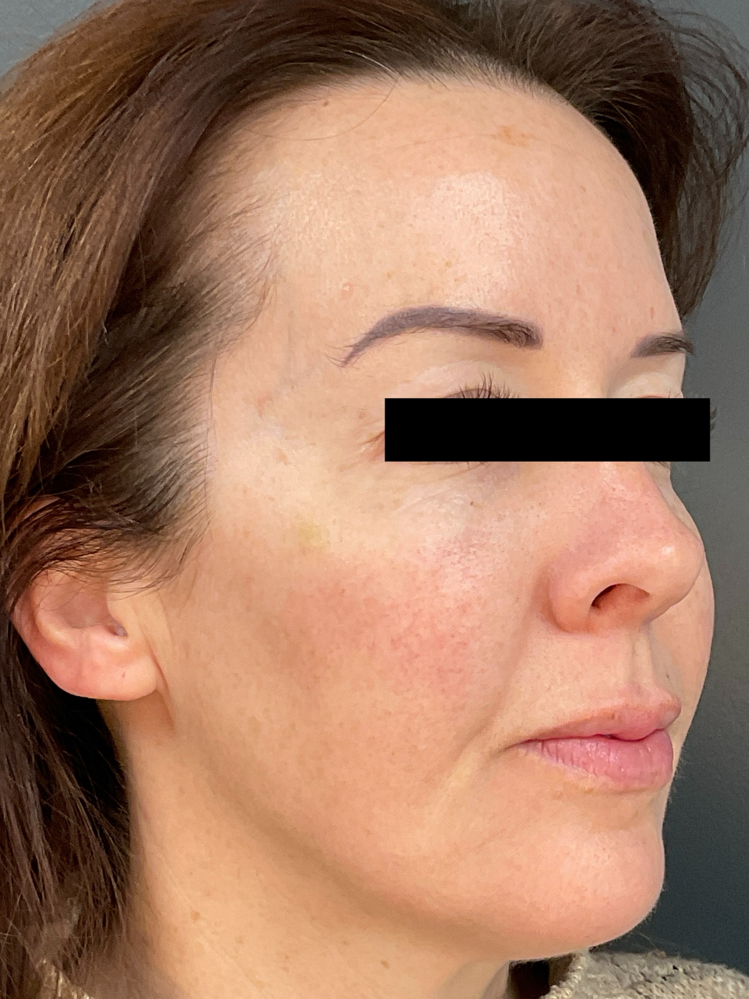 Contour: Right Angle-after