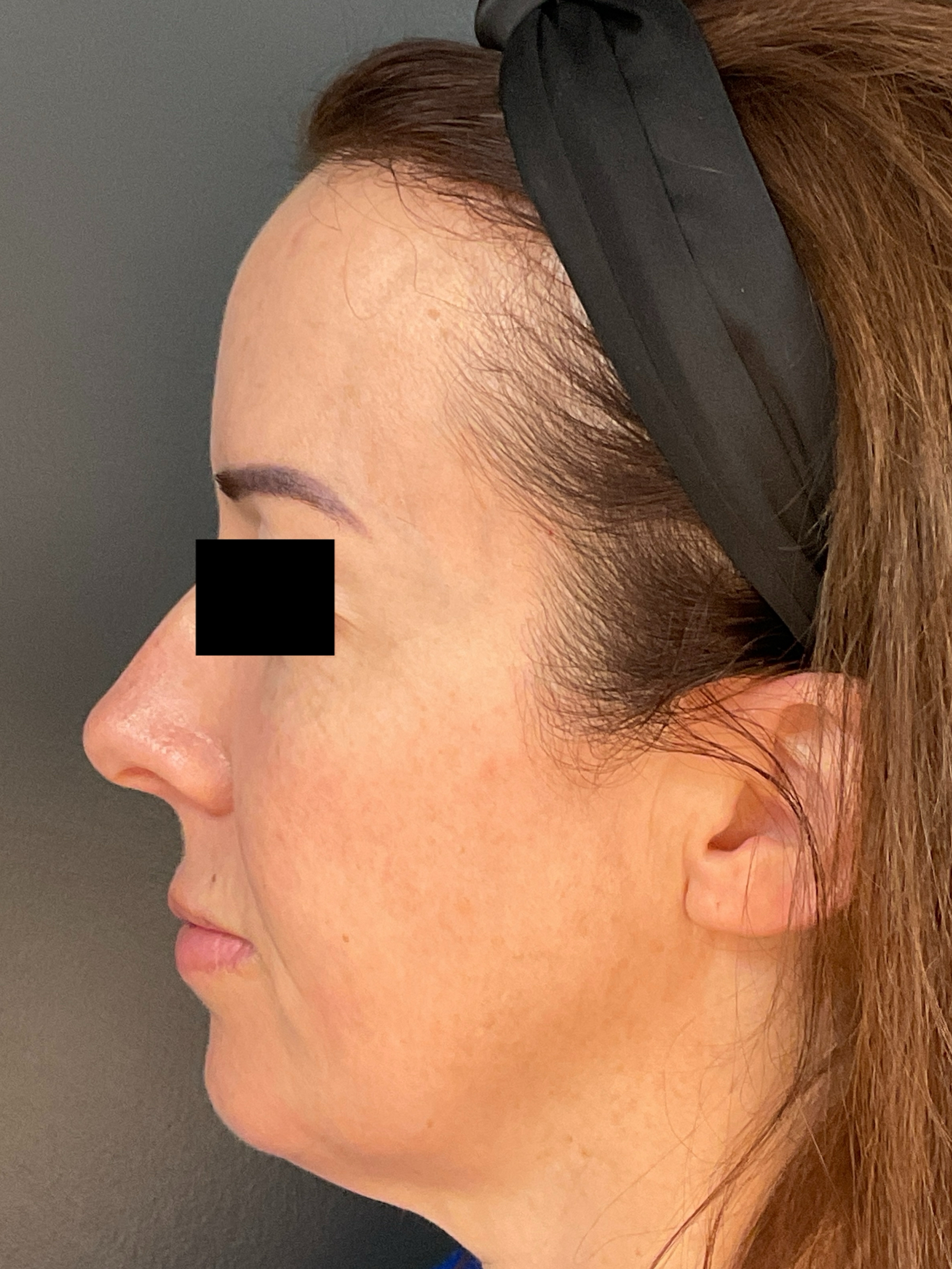 Contour: Left Profile-before