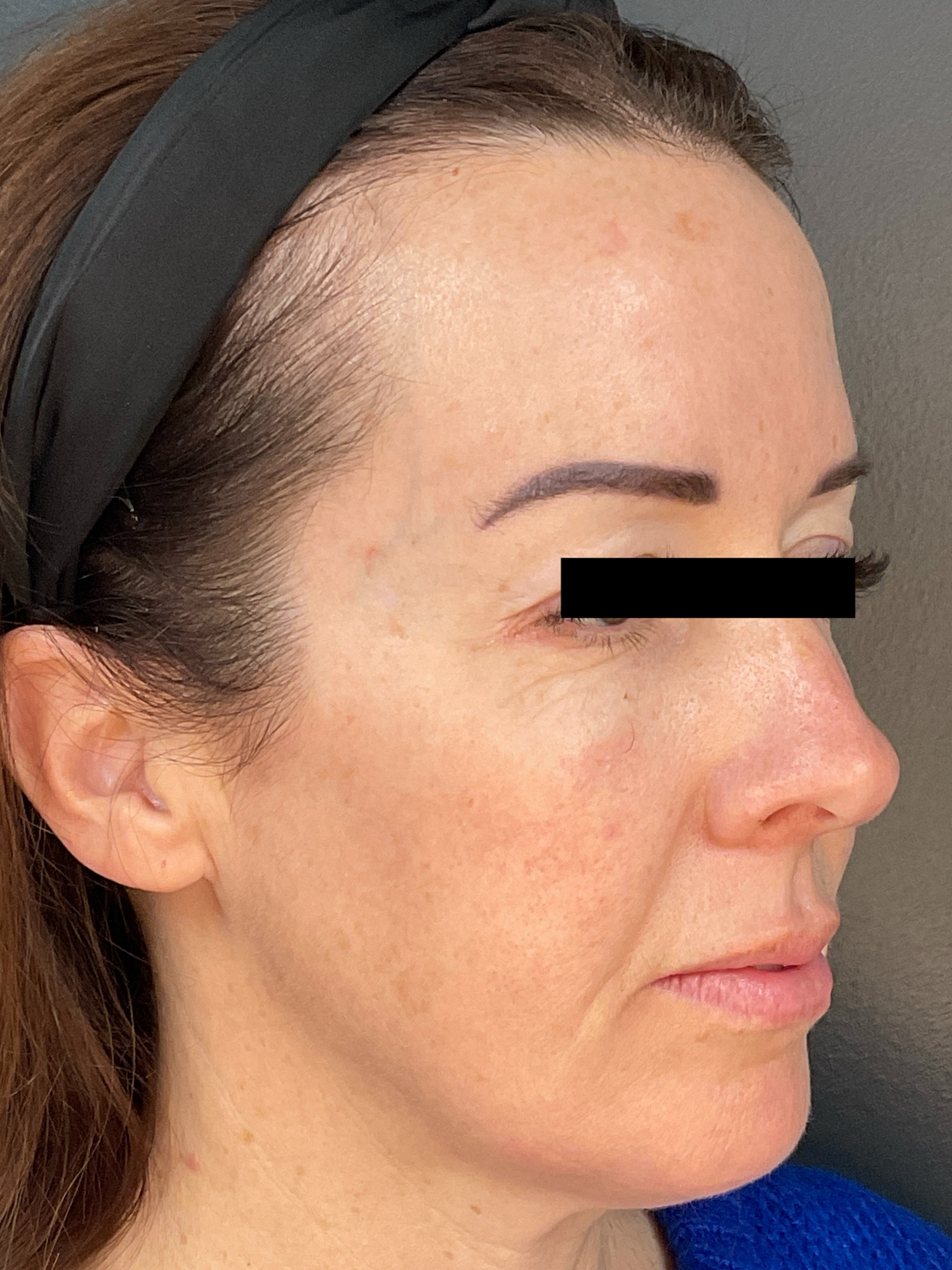 Contour: Right Angle-before