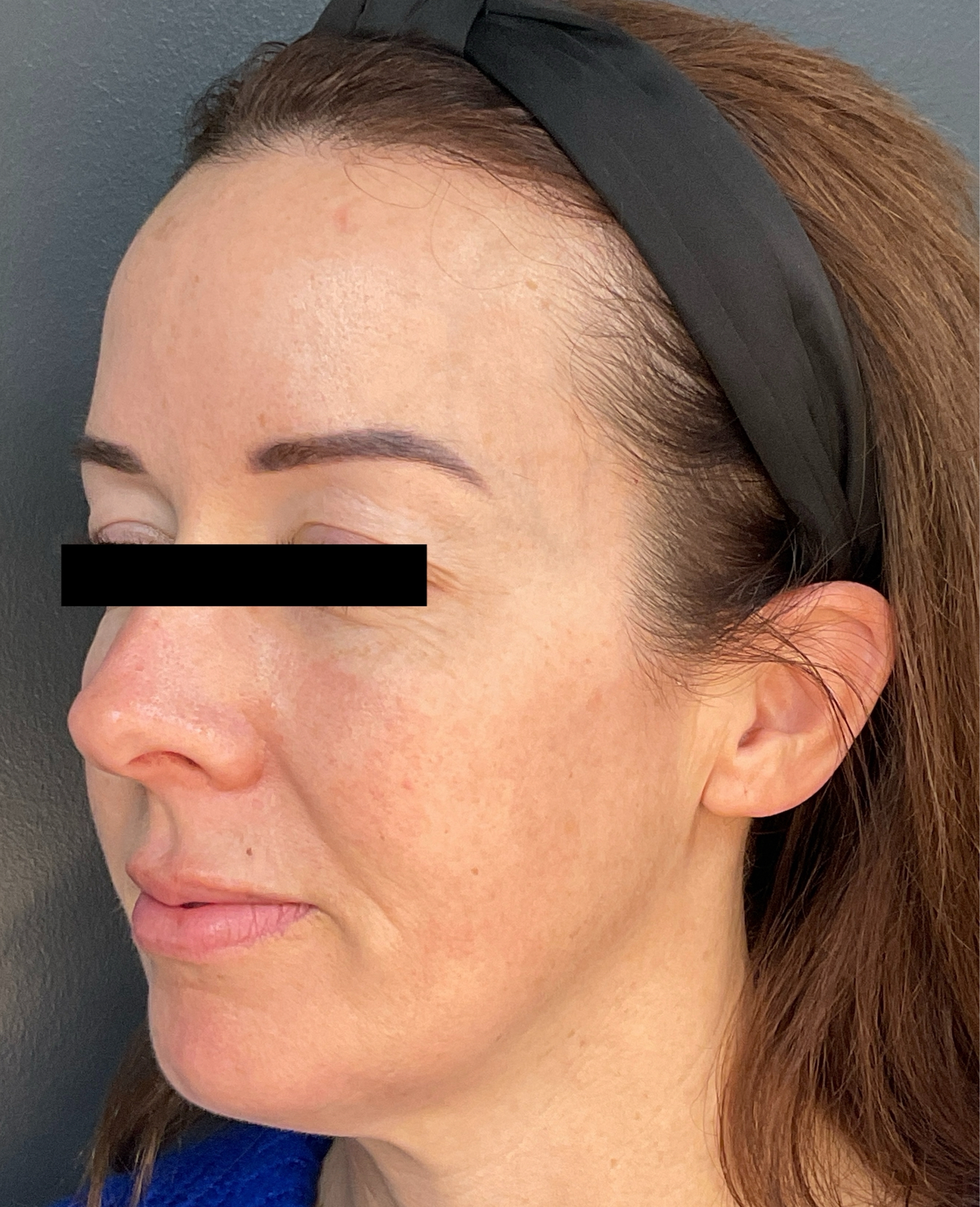 Contour: Left Angle-before