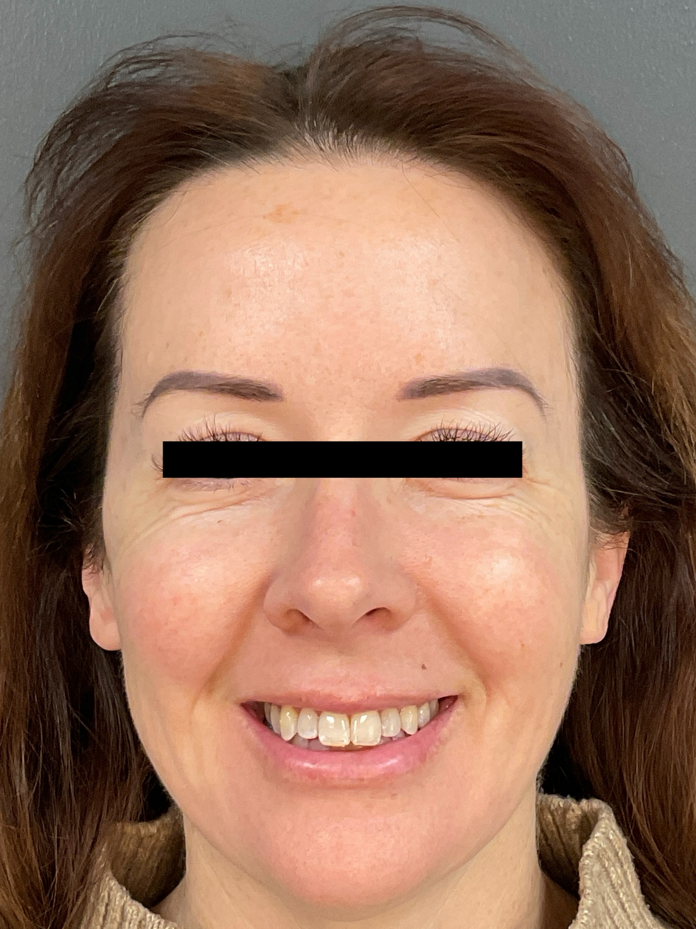 Contour: Smiling-after