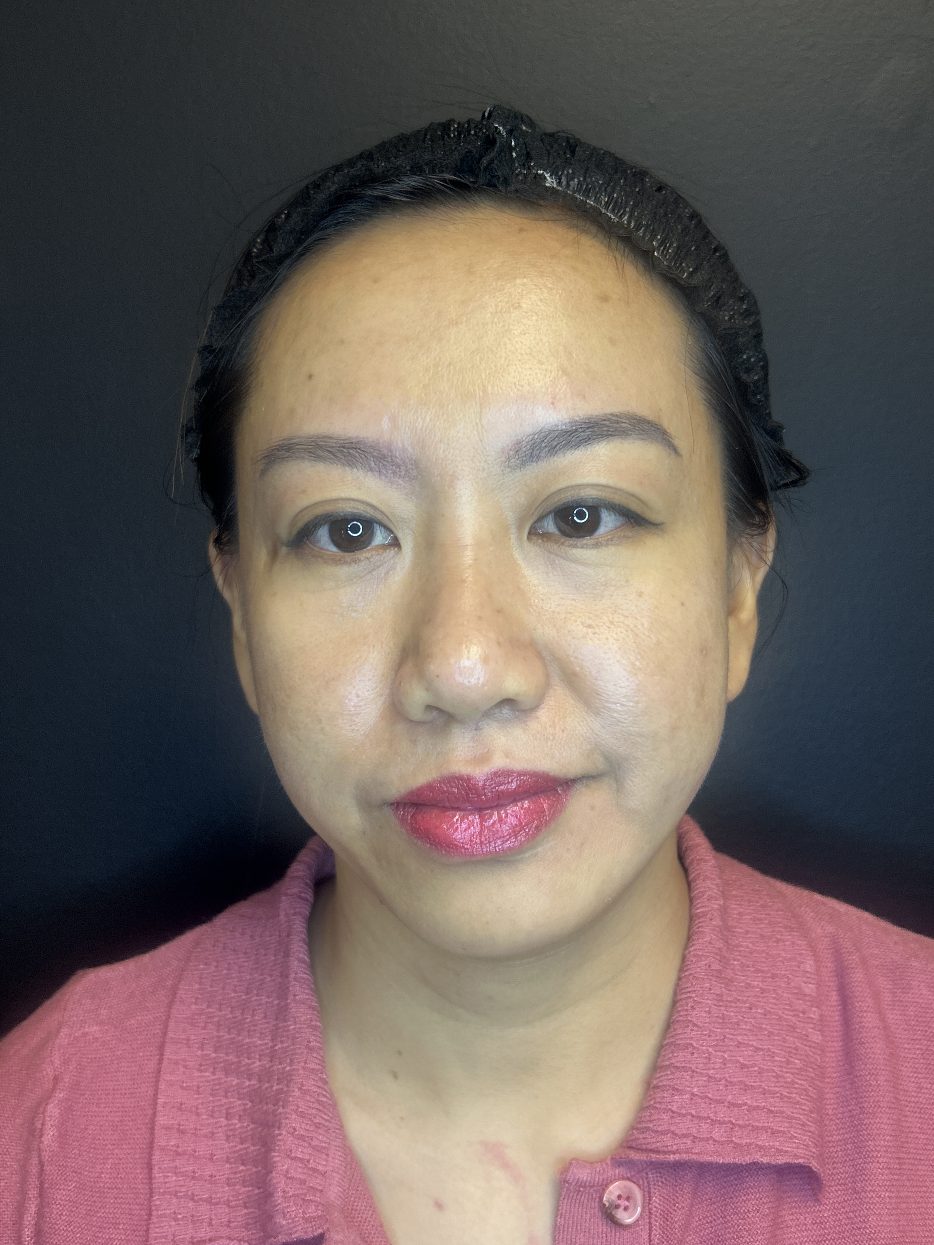 MICRONEEDLING WITH PRP AND INJECTION-after