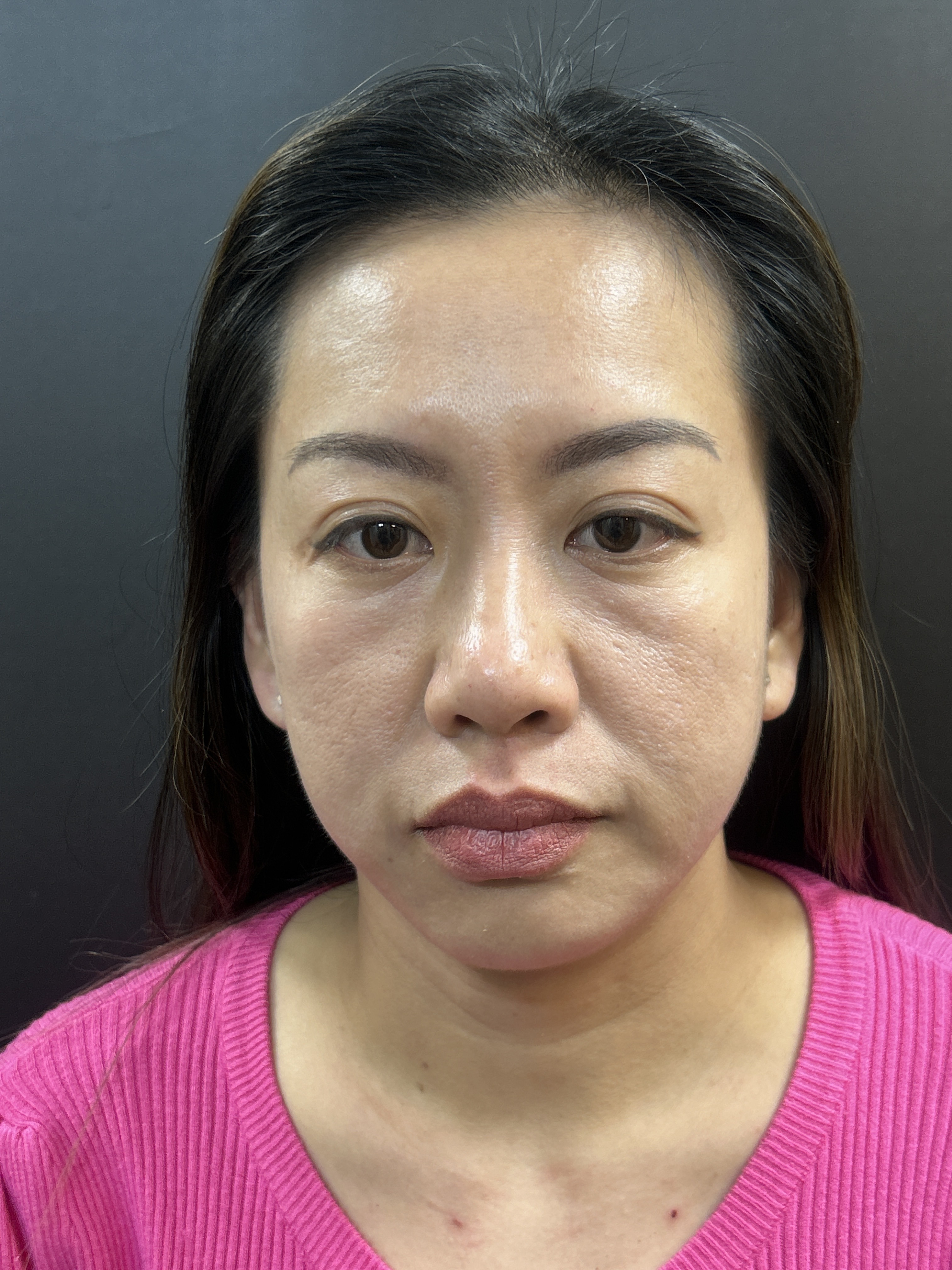 MICRONEEDLING WITH PRP AND INJECTION-before