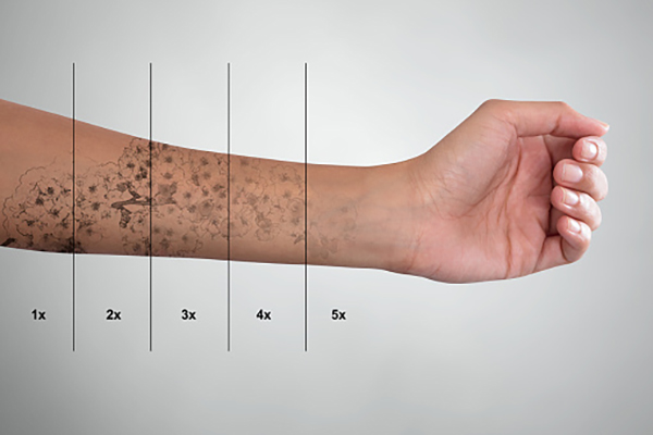 Laser Tattoo Removal