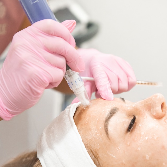 Microneedling