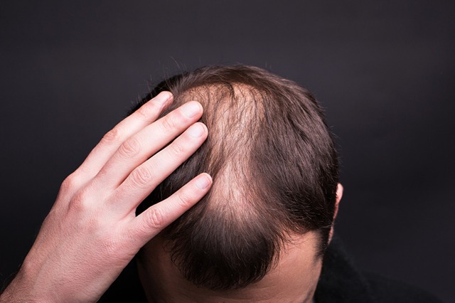 Hair Loss Treatments